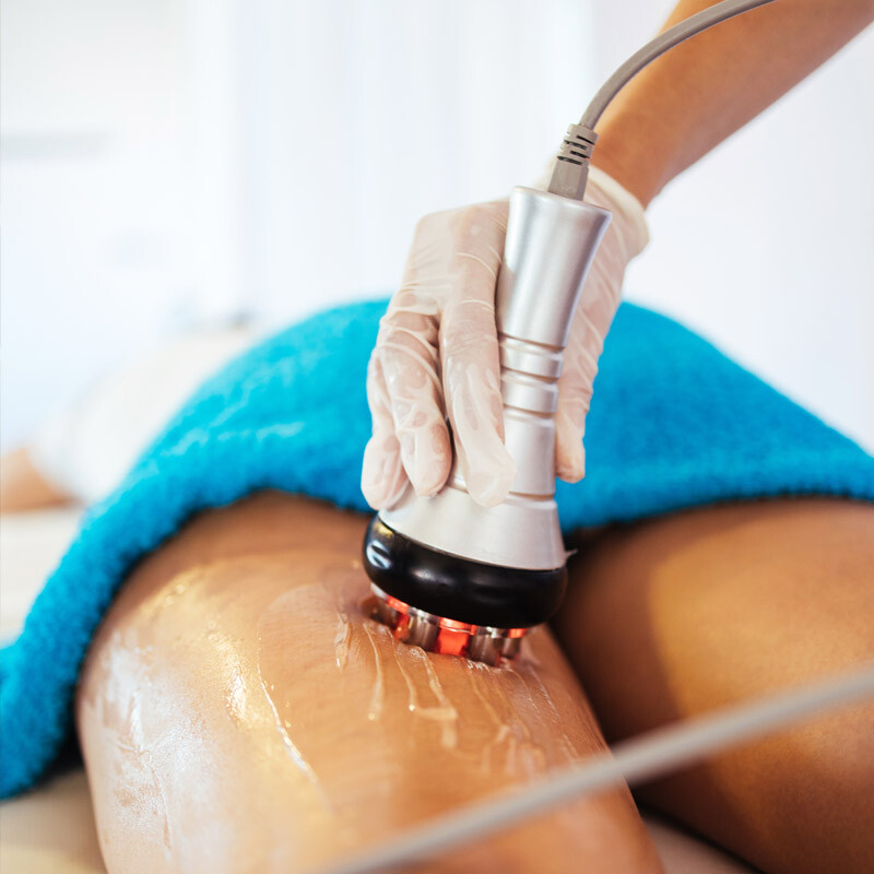 Radiofréquence d'amincissement utilisé sur la cuisse d'une femme chez EPILOUNGE
