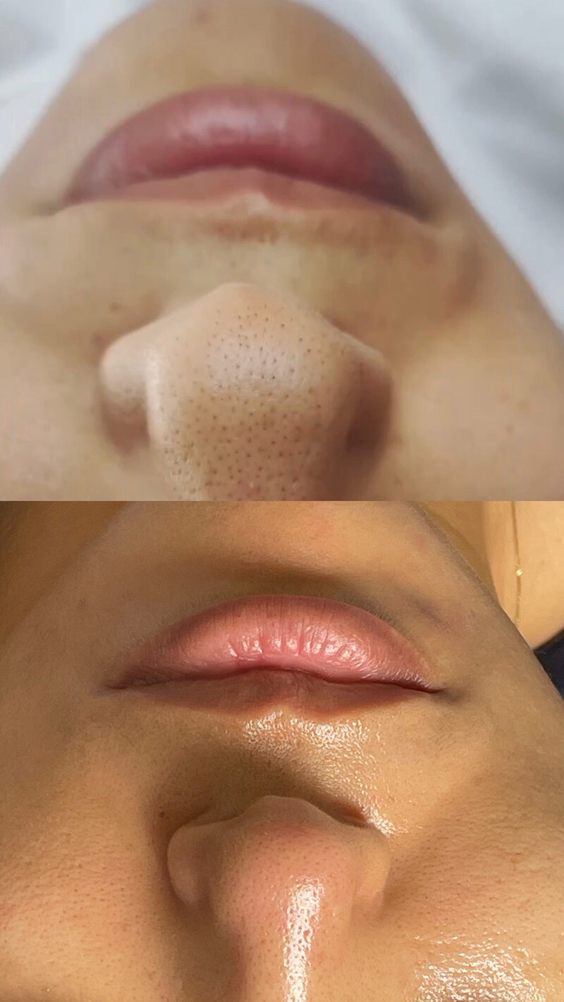 Avant-Après d'un hydrafacial visage réussi pour une cliente EPILOUNGE