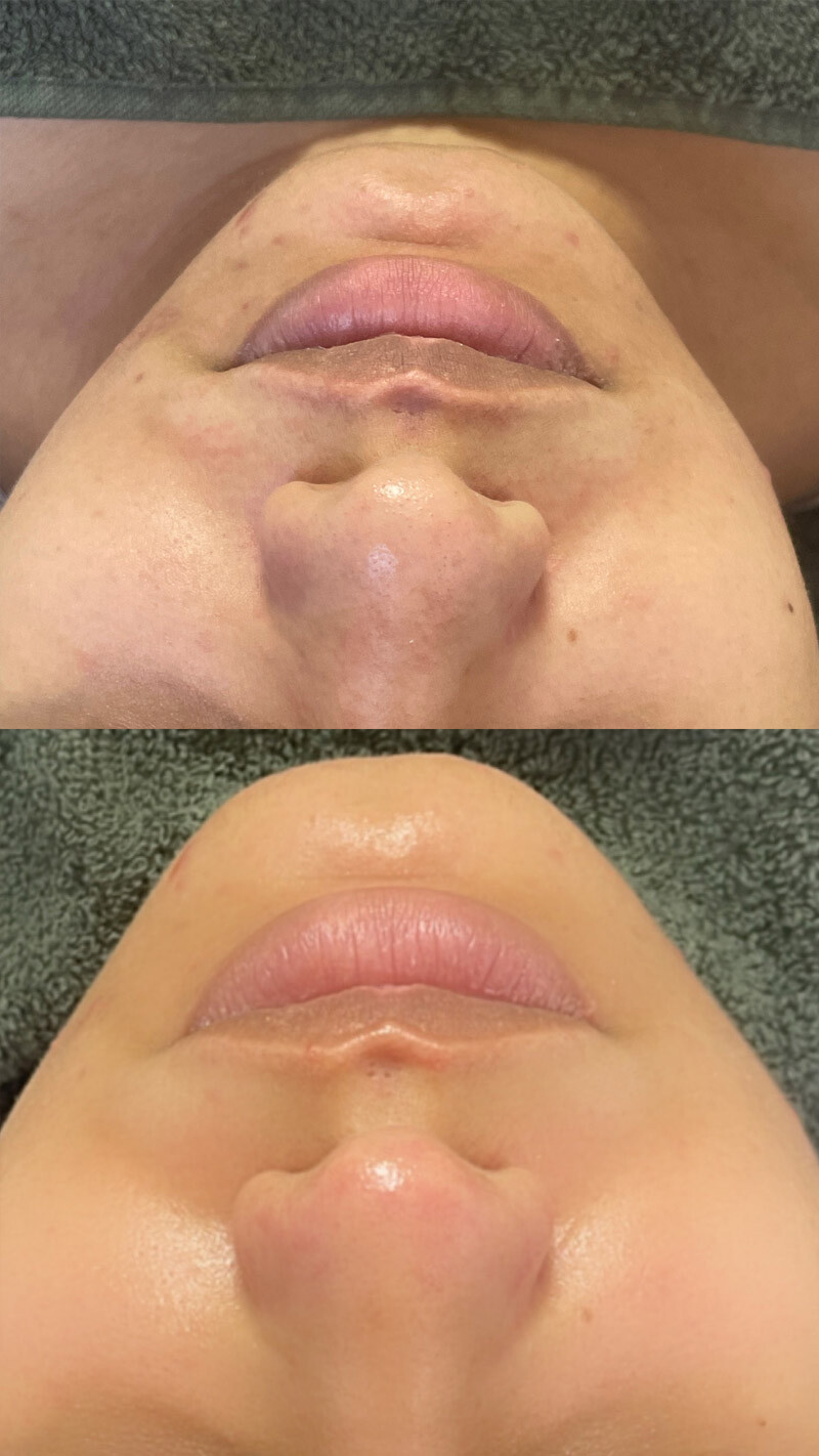 Visage d'une cliente EPILOUNGE avant et après un Hydrafacail réussi